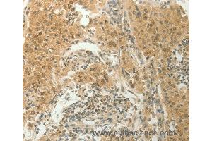 Immunohistochemistry of Human lung cancer using SLC8A3 Polyclonal Antibody at dilution of 1:70 (SLC8A3 anticorps)