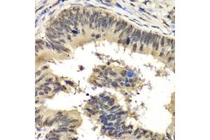 Immunohistochemistry of paraffin-embedded human colon carcinoma using RBBP5 antibody at dilution of 1:100 (x40 lens). (RBBP5 anticorps)
