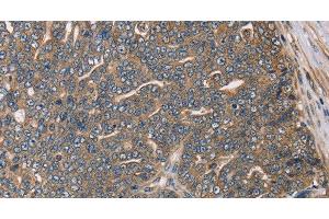 Immunohistochemistry of paraffin-embedded Human cervical cancer using HSD17B12 Polyclonal Antibody at dilution of 1:30 (HSD17B12 anticorps)