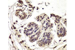 Immunohistochemistry of paraffin-embedded Human breast cancer using INTS6 Polyclonal Antibody at dilution of 1:100 (40x lens). (INTS6 anticorps)