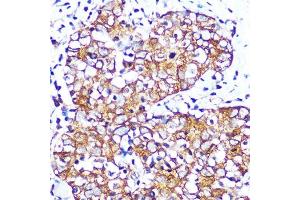 Immunohistochemistry of paraffin-embedded human esophageal cancer using Muscarinic AChR M2 (Muscarinic AChR M2 ) Rabbit mAb (ABIN7266346) at dilution of 1:100 (40x lens).