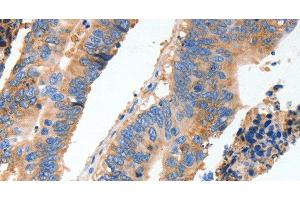 Immunohistochemistry of paraffin-embedded Human colon cancer tissue using MUC6 Polyclonal Antibody at dilution 1:40