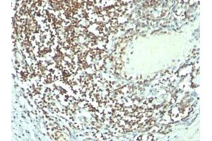 Formalin-fixed, paraffin-embedded human Bladder carcinoma stained with Nucleolin MAb (364-5 + NCL/902). (Nucleolin anticorps)