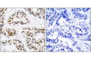 Immunohistochemistry analysis of paraffin-embedded human breast carcinoma, using RelB (Phospho-Ser552) Antibody. (RELB anticorps  (pSer573))