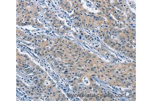 Immunohistochemistry of Human gastric cancer using KLF7 Polyclonal Antibody at dilution of 1:60