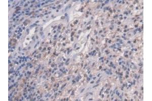 Detection of NAGLU in Human Colorectal cancer Tissue using Polyclonal Antibody to N-Acetyl Alpha-D-Glucosaminidase (NAGLU)