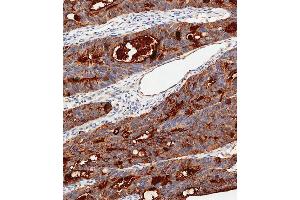 Immunohistochemical analysis of paraffin-embedded Human colon carcinoma tissue using C performed on the Leica® BOND RXm. (CEA anticorps  (AA 400-429))