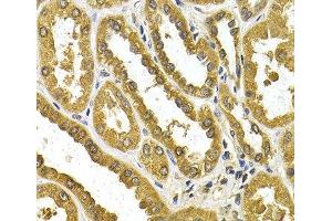 Immunohistochemistry of paraffin-embedded Human kidney cancer using UGT1A4 Polyclonal Antibody at dilution of 1:200 (40x lens). (UGT1A4 anticorps)