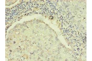 Immunohistochemistry of paraffin-embedded human lung cancer using ABIN7168449 in 30 μg/mL dilute concentrations.