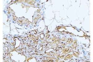 ABIN6275232 at 1/100 staining Human lung cancer tissue by IHC-P. (MRPS2 anticorps  (C-Term))