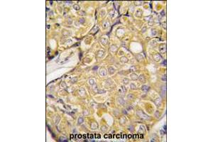 Formalin-fixed and paraffin-embedded human prostata carcinoma tissue reacted with , which was peroxidase-conjugated to the secondary antibody, followed by DAB staining. (TRPM8 anticorps  (AA 521-552))