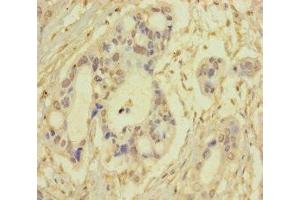 Immunohistochemistry of paraffin-embedded human pancreatic cancer using ABIN7170681 at dilution of 1:100 (SRPK3 anticorps  (AA 1-300))