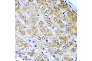 Immunohistochemistry of paraffin-embedded human liver cancer using BMF antibody at dilution of 1:200 (40x lens).