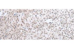 Immunohistochemistry of paraffin-embedded Human ovarian cancer tissue using HOXC11 Polyclonal Antibody at dilution of 1:25(x200) (HOXC11 anticorps)