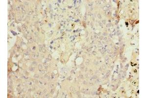Immunohistochemistry of paraffin-embedded human lung cancer using ABIN7149271 at dilution of 1:100