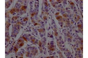 IHC image of ABIN7127454 diluted at 1:100 and staining in paraffin-embedded human breast cancer performed on a Leica BondTM system.