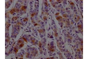 IHC image of ABIN7127454 diluted at 1:100 and staining in paraffin-embedded human breast cancer performed on a Leica BondTM system. (Recombinant Dihydrofolate Reductase anticorps)