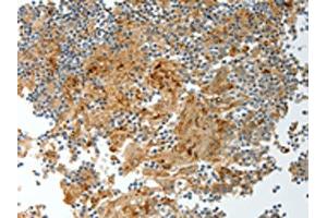 The image on the left is immunohistochemistry of paraffin-embedded Human tonsil tissue using ABIN7130695(PRCP Antibody) at dilution 1/20, on the right is treated with fusion protein. (PRCP anticorps)