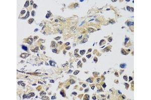 Immunohistochemistry of paraffin-embedded Human lung cancer using C12orf10 Polyclonal Antibody at dilution of 1:100 (40x lens). (C12orf10 anticorps)