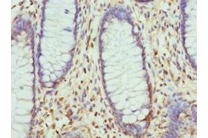 Immunohistochemistry of paraffin-embedded human colon cancer using ABIN7158341 at dilution of 1:100