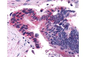 Anti-FZD5 / Frizzled 5 antibody IHC of human Colon, Carcinoma.