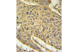 AGER Antibody IHC analysis in formalin fixed and paraffin embedded human lung carcinoma followed by peroxidase conjugation of the secondary antibody and DAB staining. (RAGE anticorps  (N-Term))