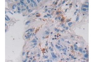 Detection of LGMN in Human Prostate cancer Tissue using Polyclonal Antibody to Legumain (LGMN)