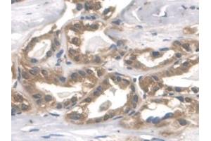 Detection of ALDOA in Human Thyroid cancer Tissue using Polyclonal Antibody to Aldolase A, Fructose Bisphosphate (ALDOA)