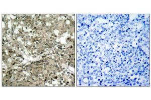 Immunohistochemical analysis of paraffin-embedded human breast carcinoma tissue using c-Abl (Ab-412) antibody (E021156). (ABL1 anticorps)