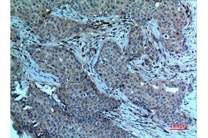Immunohistochemistry (IHC) analysis of paraffin-embedded Human Breast Cancer, antibody was diluted at 1:100.