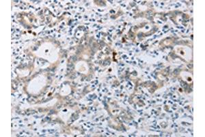 The image on the left is immunohistochemistry of paraffin-embedded Human gastic cancer tissue using ABIN7189583(ABCB9 Antibody) at dilution 1/15, on the right is treated with synthetic peptide. (ABCB9 anticorps)