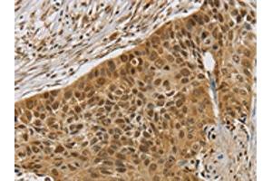 The image on the left is immunohistochemistry of paraffin-embedded Human esophagus cancer tissue using ABIN7192565(SMC6 Antibody) at dilution 1/30, on the right is treated with synthetic peptide. (SMC6 anticorps)