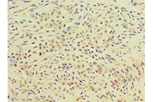 Immunohistochemistry of paraffin-embedded human breast cancer using ABIN7166414 at dilution of 1:100
