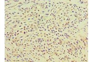 Immunohistochemistry of paraffin-embedded human breast cancer using ABIN7166414 at dilution of 1:100 (Transglutaminase 2 anticorps  (AA 438-687))