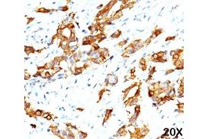 IHC testing of breast carcinoma (20X) stained with HSP27 antibody (G3. (HSP27 anticorps)
