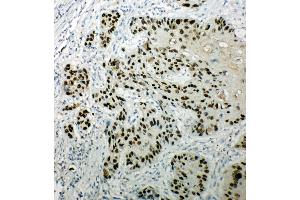Anti-p63 antibody, IHC(P) IHC(P): Human Esophageal Squamous Cell Carcinoma Tissue