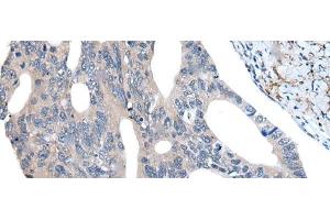 Immunohistochemistry of paraffin-embedded Human colorectal cancer tissue using UBR4 Polyclonal Antibody at dilution of 1:55(x200)