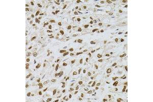 Immunohistochemistry of paraffin-embedded human lung cancer using TGM2 antibody. (Transglutaminase 2 anticorps)