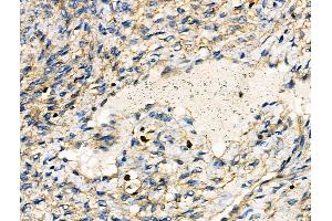 ABIN6262655 and ABIN6276467 at 1/100 staining Human ovarian cancer and adjacent normal tissues by IHC-P. (IRF4 anticorps  (C-Term))