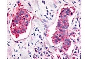Anti-ELTD1 antibody IHC of human Breast, Carcinoma. (ELTD1 anticorps  (C-Term))