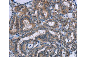 Immunohistochemistry of Human colon cancer using PLIN1 Polyclonal Antibody at dilution of 1:30 (PLIN1 anticorps)