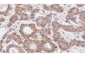 ABIN6272681 at 1/100 staining Human liver cancer tissue by IHC-P. (CCR4 anticorps  (N-Term))