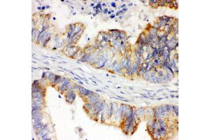 Anti- HIF 1 alpha Picoband antibody,IHC(P) IHC(P): Human Intestinal Cancer Tissue