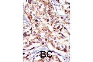 Formalin-fixed and paraffin-embedded human cancer tissue reacted with SRC polyclonal antibody  , which was peroxidase-conjugated to the secondary antibody, followed by DAB staining. (Src anticorps  (N-Term))