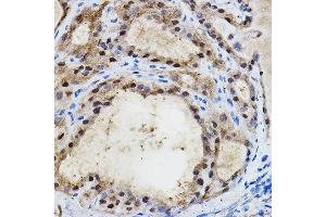 Immunohistochemistry of paraffin-embedded human thyroid cancer using EP/HIF2α Rabbit pAb (ABIN6127869, ABIN6141764, ABIN6141765 and ABIN6223457) at dilution of 1:100 (40x lens).