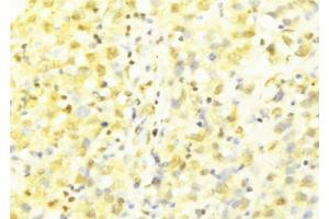 ABIN6277633 at 1/100 staining Human breast cancer tissue by IHC-P.