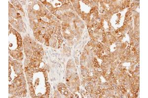 IHC-P Image Immunohistochemical analysis of paraffin-embedded N87 xenograft, using SLC25A13, antibody at 1:500 dilution. (slc25a13 anticorps)