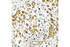 Immunohistochemistry of paraffin-embedded human gastric cancer using TAPBP Antibody. (TAPBP anticorps)