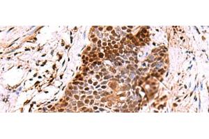 Immunohistochemistry of paraffin-embedded Human esophagus cancer tissue using POLD2 Polyclonal Antibody at dilution of 1:60(x200) (POLD2 anticorps)