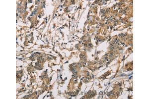 Immunohistochemistry of Human colon cancer using CBR1 Polyclonal Antibody at dilution of 1:40 (CBR1 anticorps)